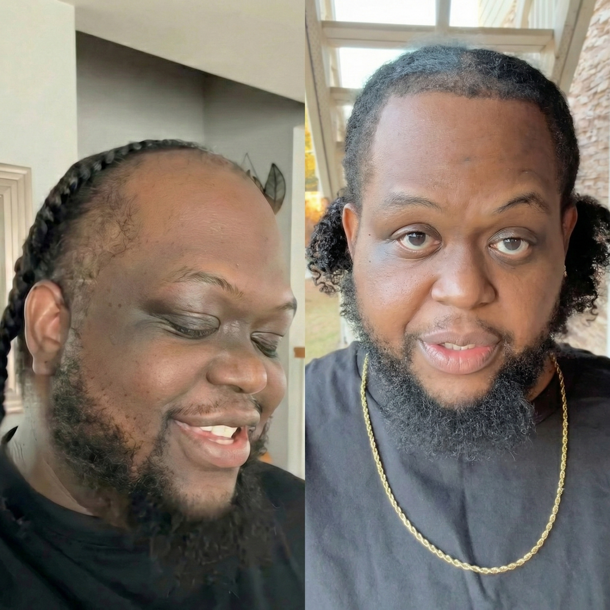 Hair Regrowth System